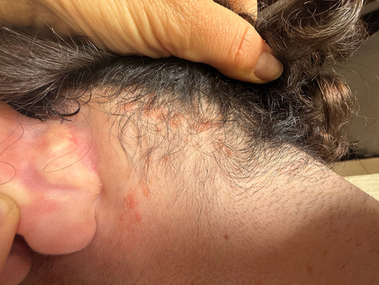 Why Your Scalp Isn’t Healing (And What No One Tells You)