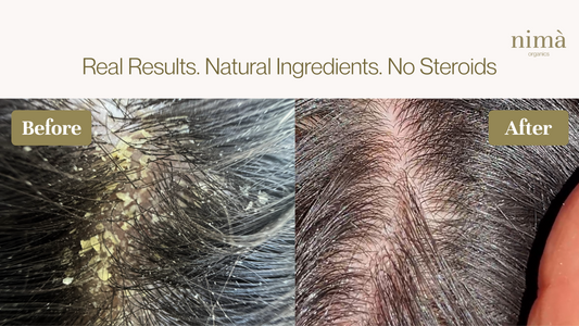 How to Get Rid of Dandruff Naturally