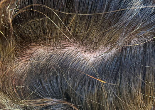 Clear scalp results after 12 days of Nima Organics natural scalp treatment