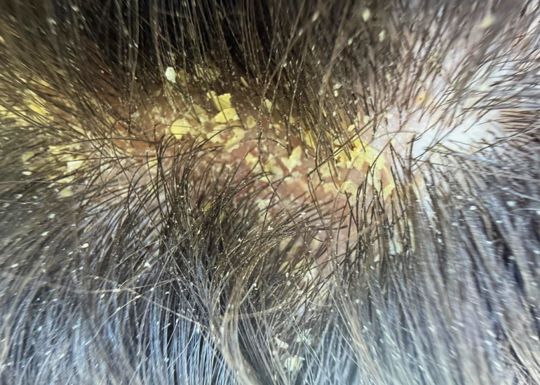 seborrheic dermatitis and severe dandruff flakes before using Nima Organics oil treatment