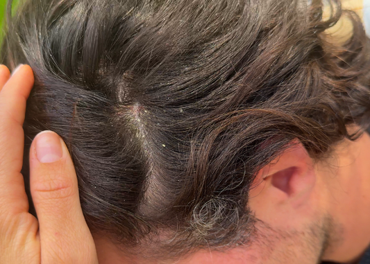 Scalp Psoriasis vs. Seb Derm vs. Dandruff - What’s the Difference?